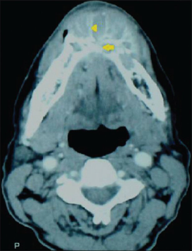 72-year-old male with a swelling in the mandible and the left lower leg, diagnosed with multiple myeloma. Computed tomography image, axial section reveals a heterogenous lesion (arrow) in the anterior mandibular body, discontinuity of the buccal cortical plate with radiating bony spicules (arrowhead).